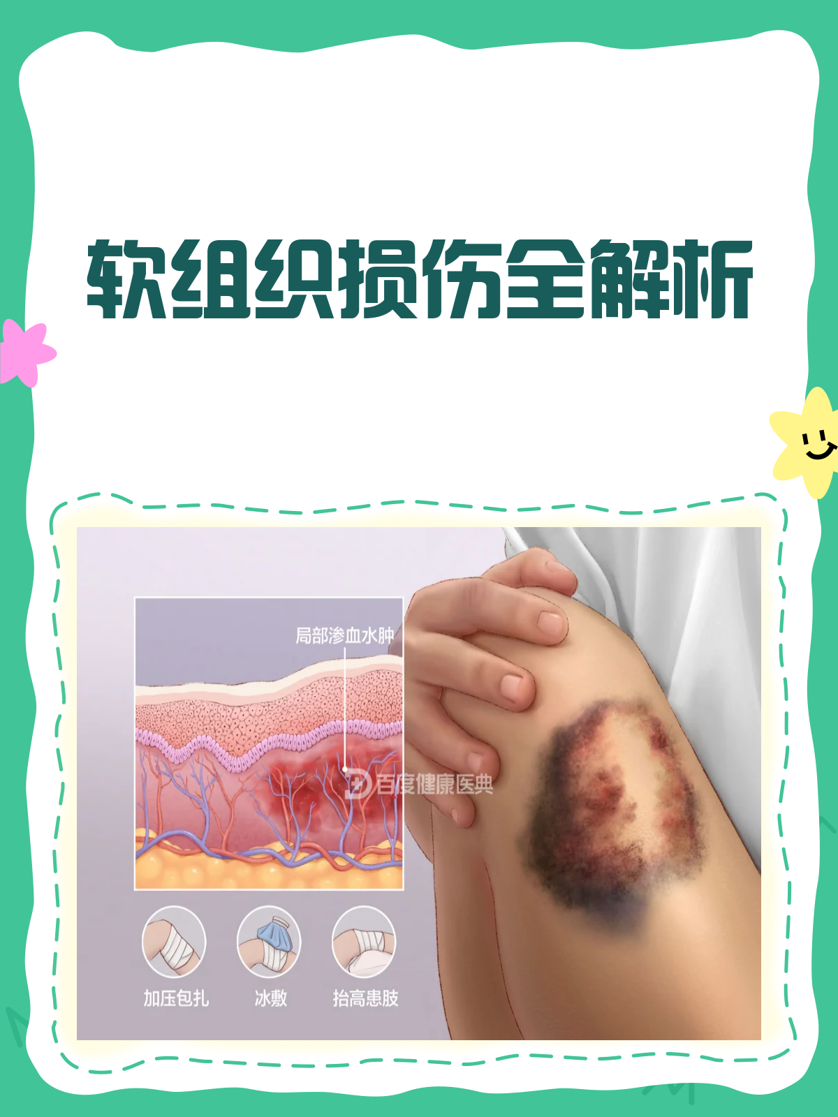 软组织损伤知多少?疼痛背后的真相揭秘!