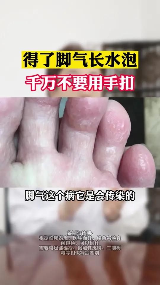 一人得了,传染全家,这是 水泡型脚气,处理并不复杂!