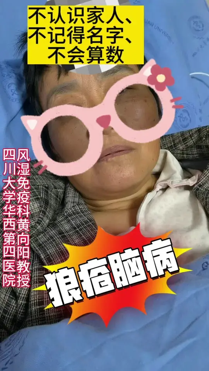 系统性红斑狼疮最严重的症状之一