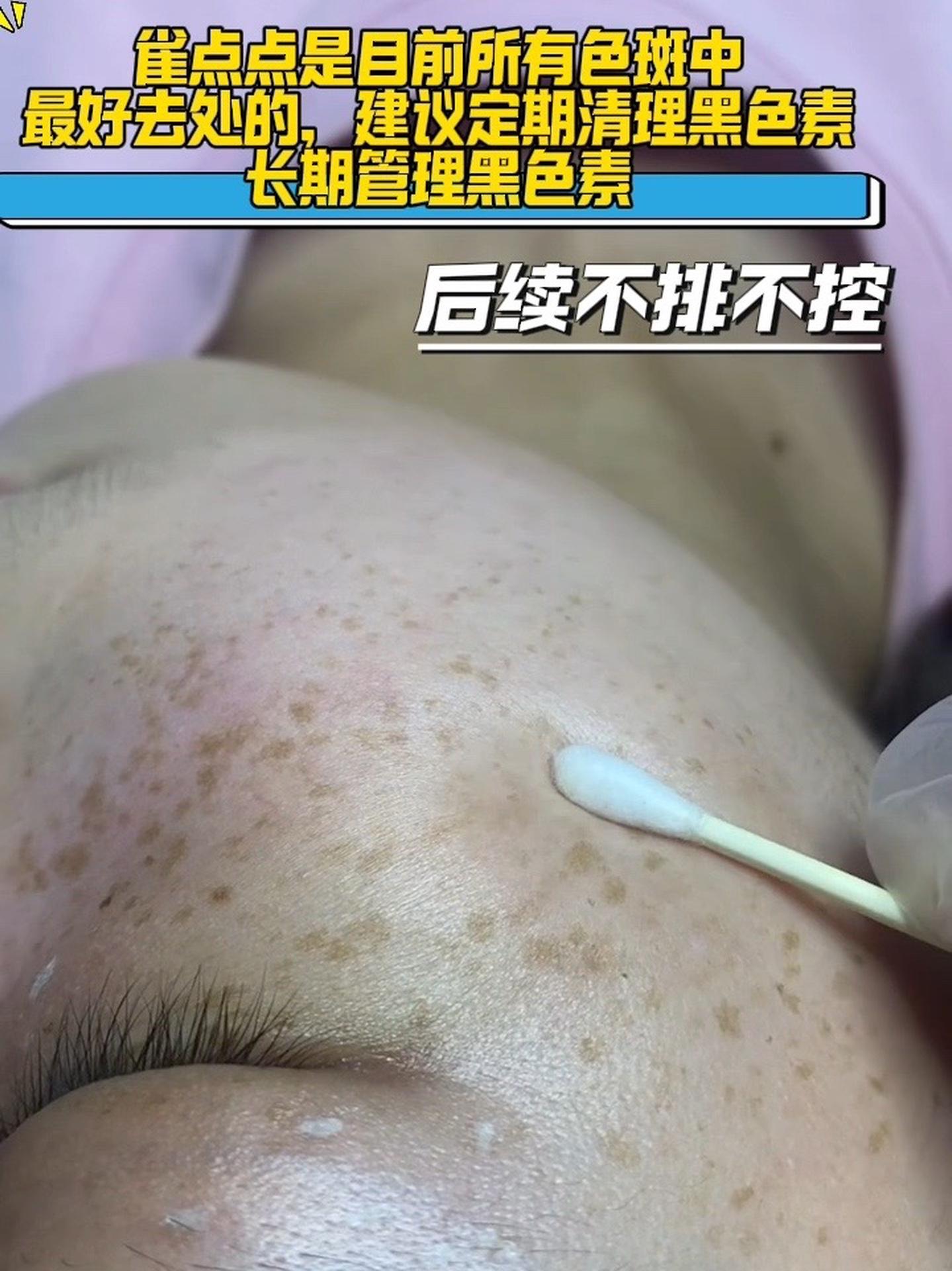 雀斑去除的最佳方法(青少年雀斑去除的最佳方法)