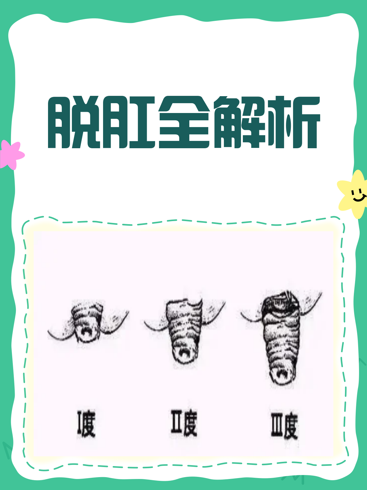 脱肛是什么?一文带你全面了解