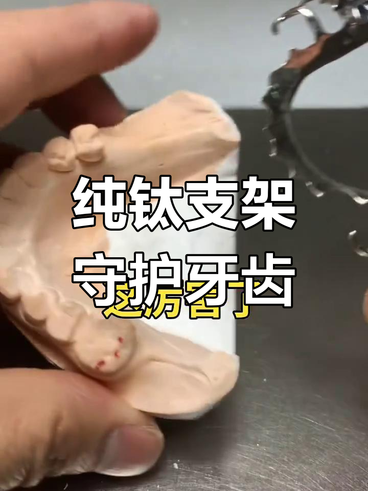 纯钛支架助力口腔健康,保护牙齿更轻松