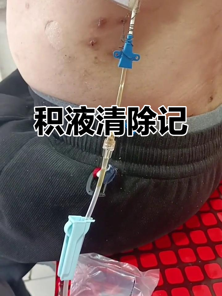 胸腔积液排出500ml,明天就能摘除引流管了