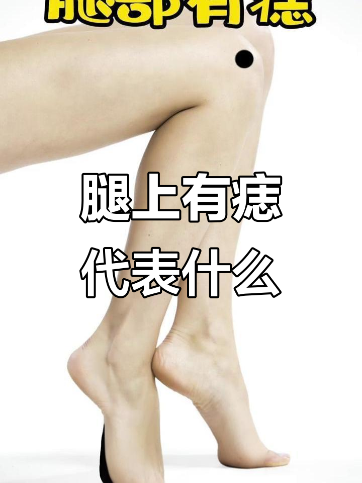 腿部痣的位置与命运,你了解吗?