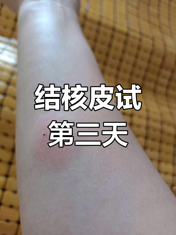 结核皮试三天后,结果如何?