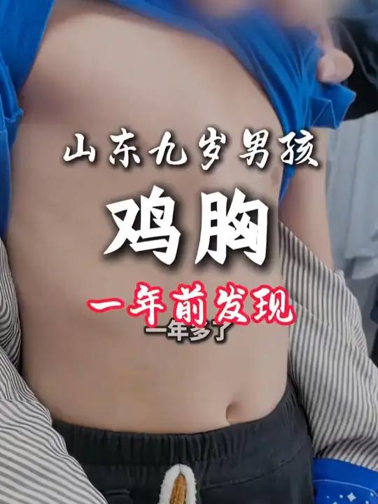 山东九岁男孩鸡胸,一年多前发现,现在越来越严重