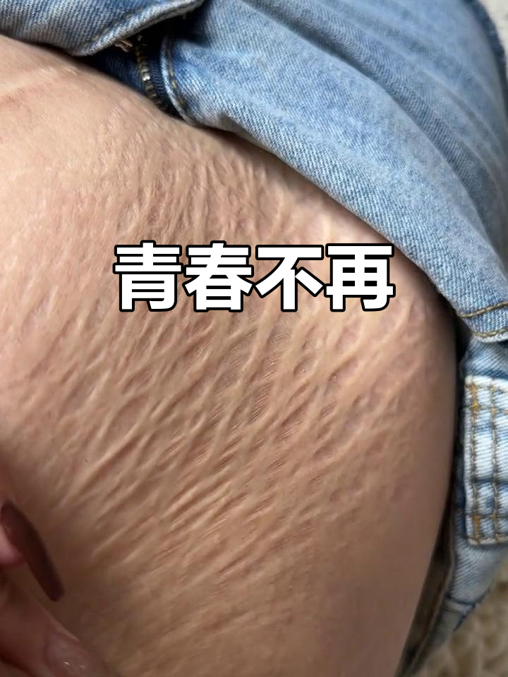 肚子上的疤痕与妊娠纹,提醒我青春已逝