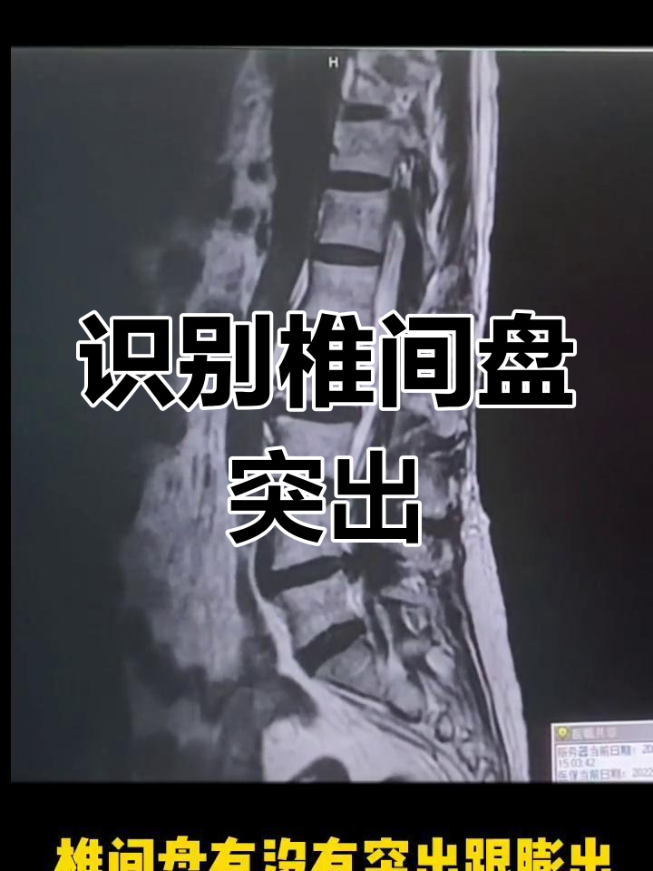 核磁共振揭示椎间盘膨出与突出差异