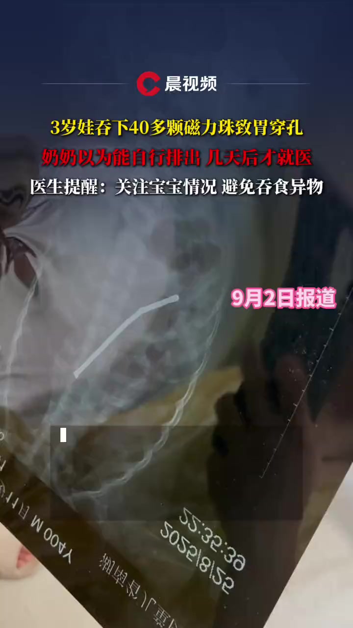 磁力珠吞到肚子里怎么办_磁力珠吃到肚子里怎么检查 磁力珠吞到肚子里怎么办_磁力珠吃到肚子里怎么查抄
（磁力珠吞进肚子怎么办） 磁力资讯