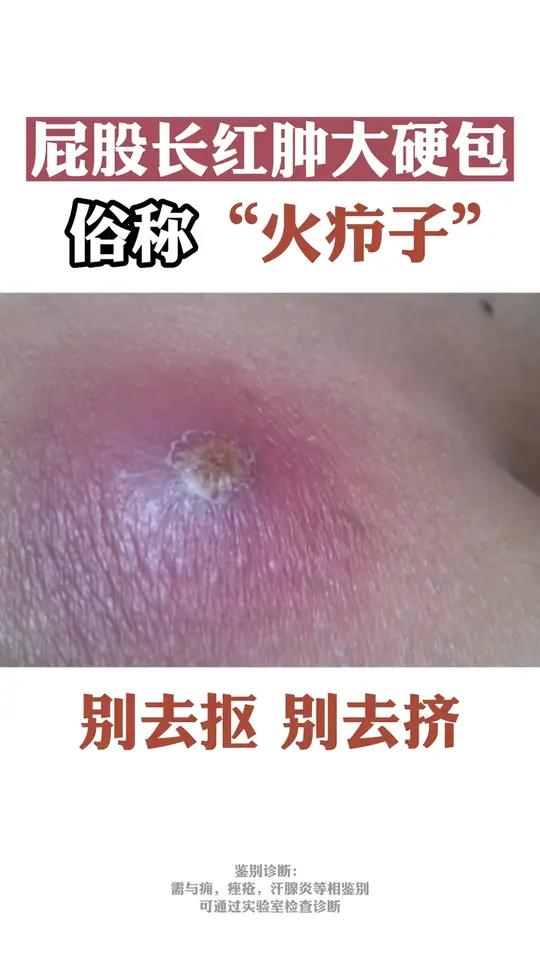 屁股上长红肿大硬包,坐都不能坐火疖子不要抠,不要挤,应该这样来处理!
