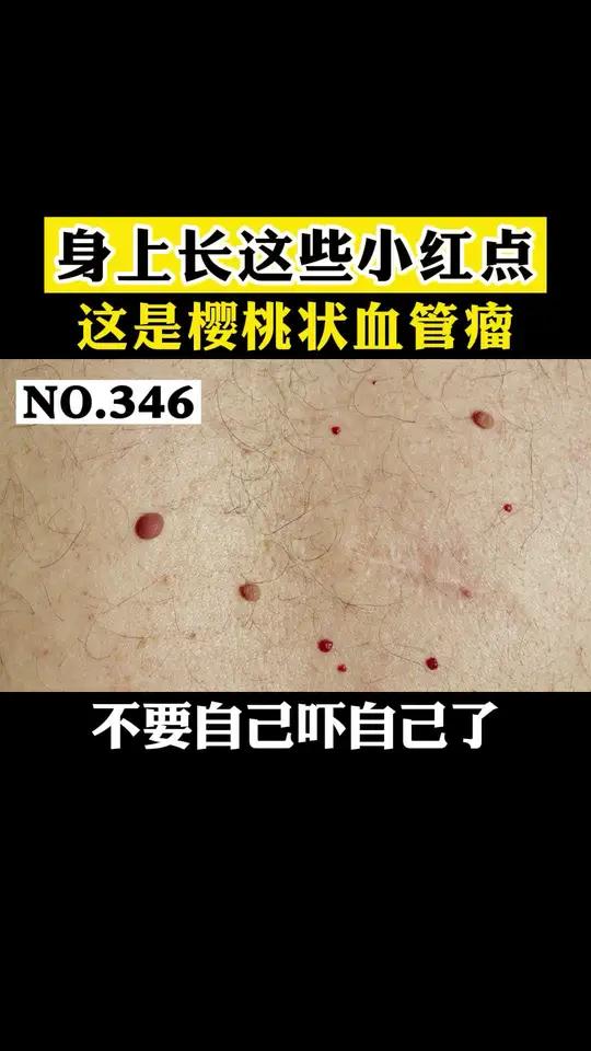 身上长这些小红点,这是樱桃状血管瘤,老年人较常见