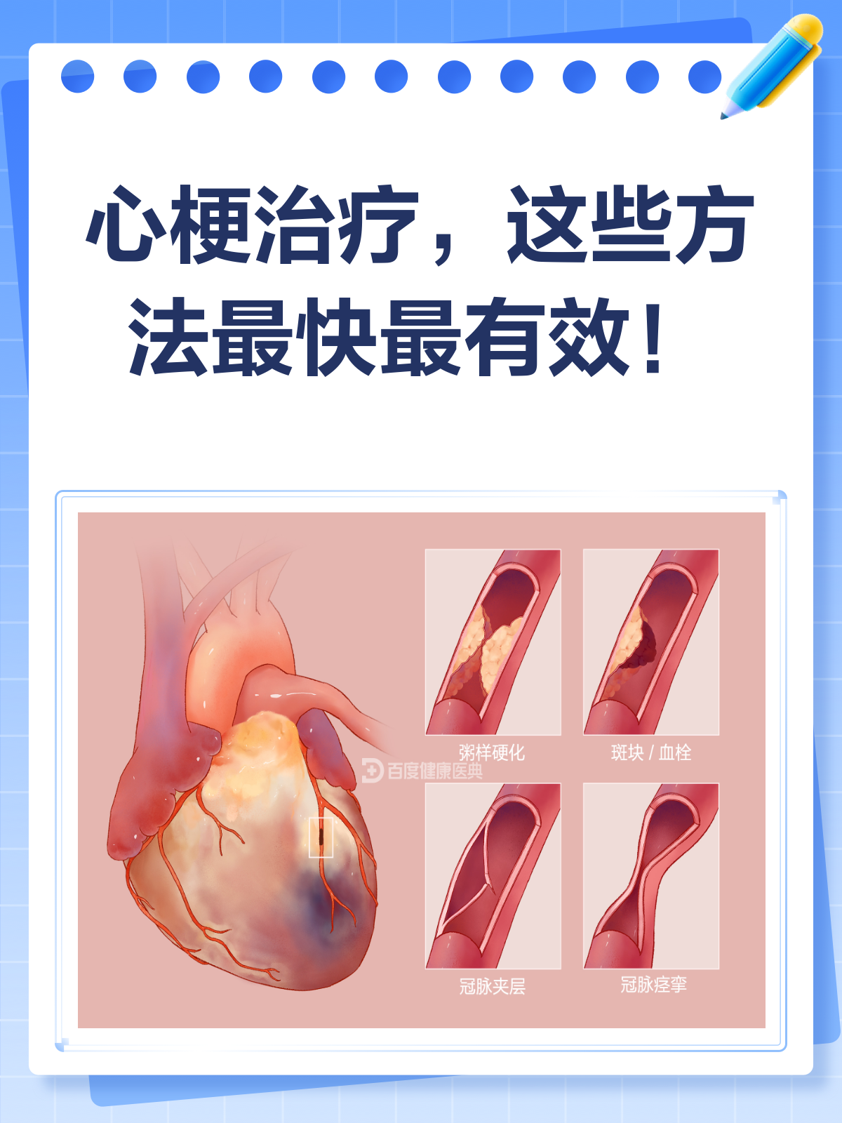 心梗治疗全攻略,快速有效是关键!