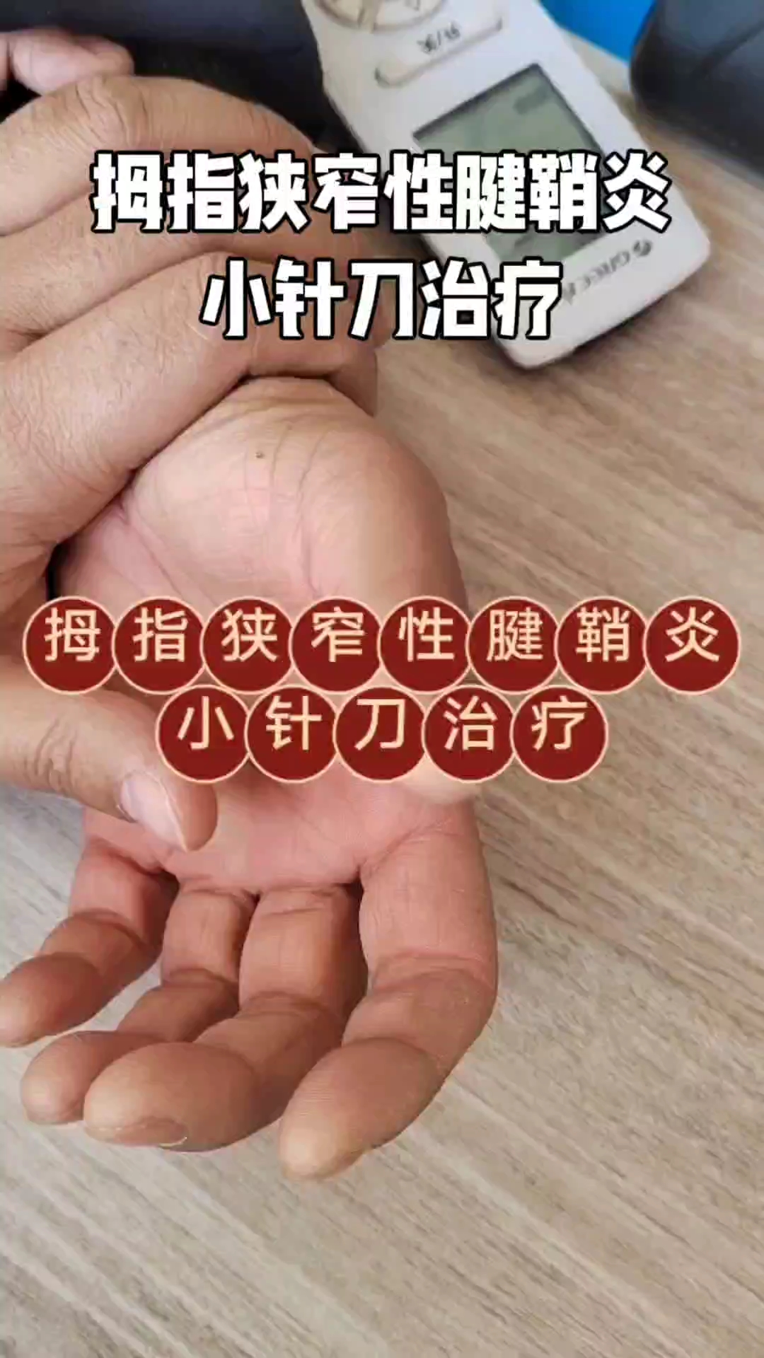 拇指狭窄性腱鞘炎小针刀治疗