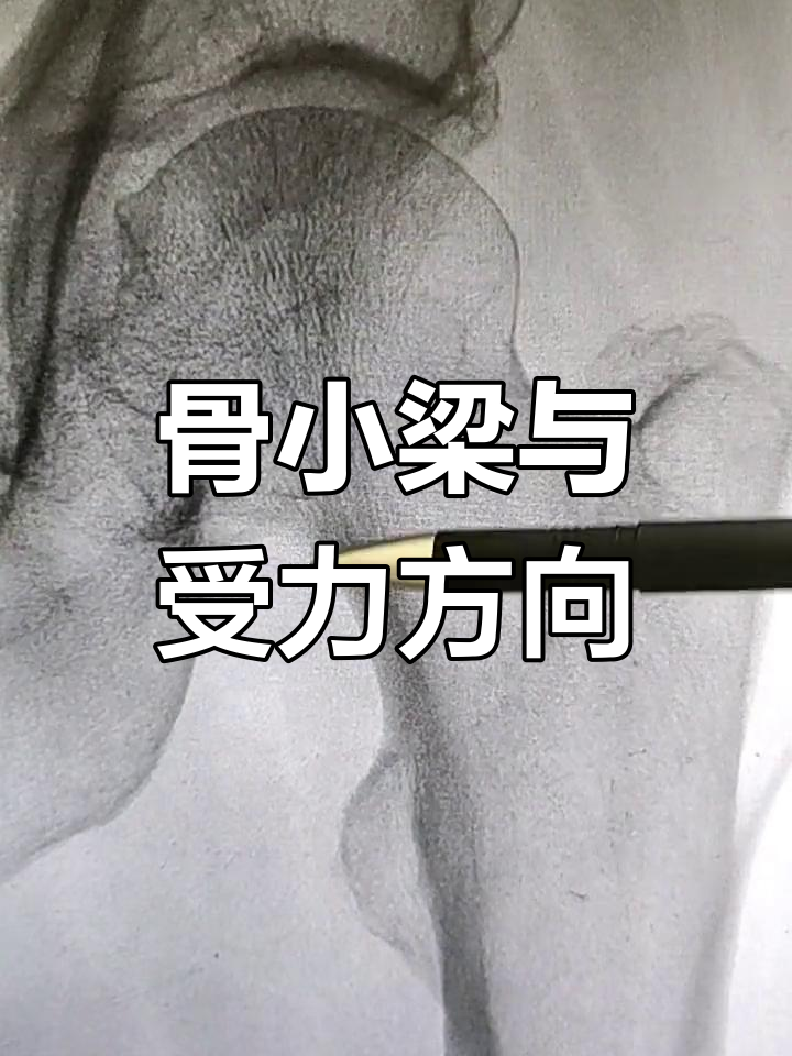 骨骼受力的关键结构:骨小梁