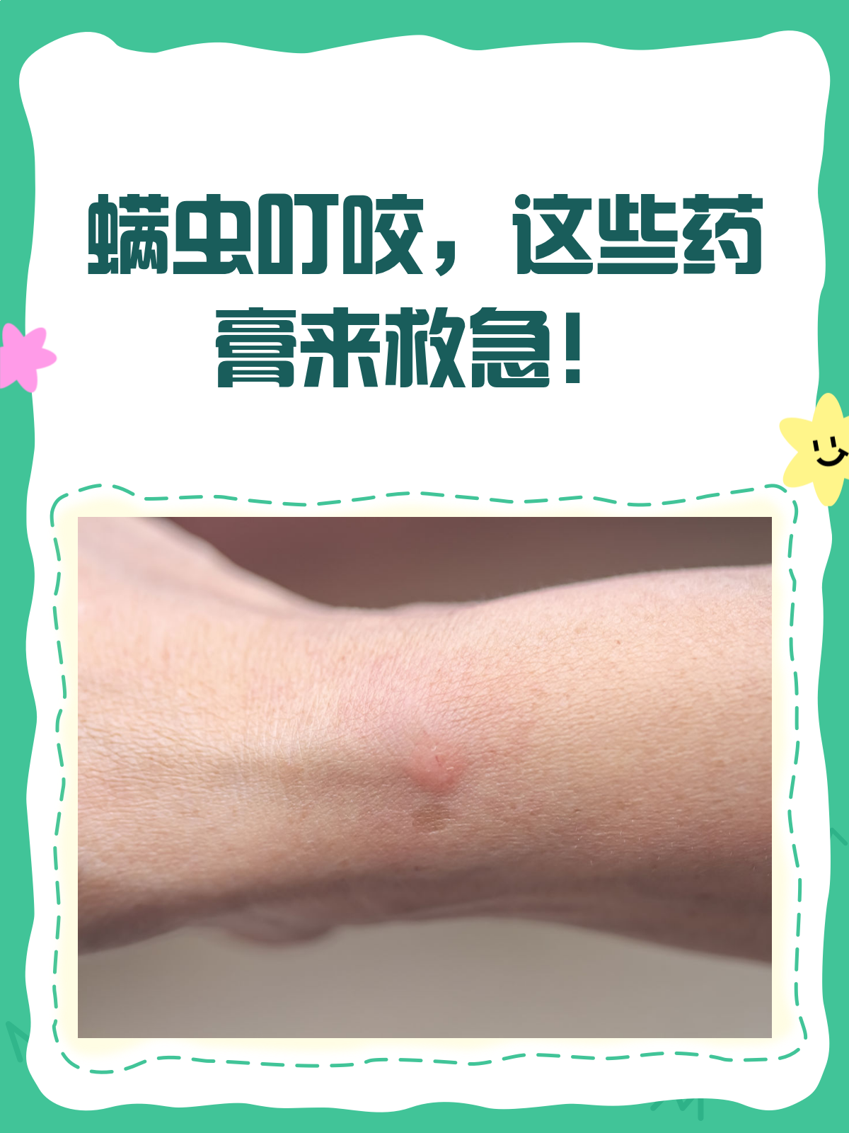 被螨虫咬了?这些药膏来帮忙!