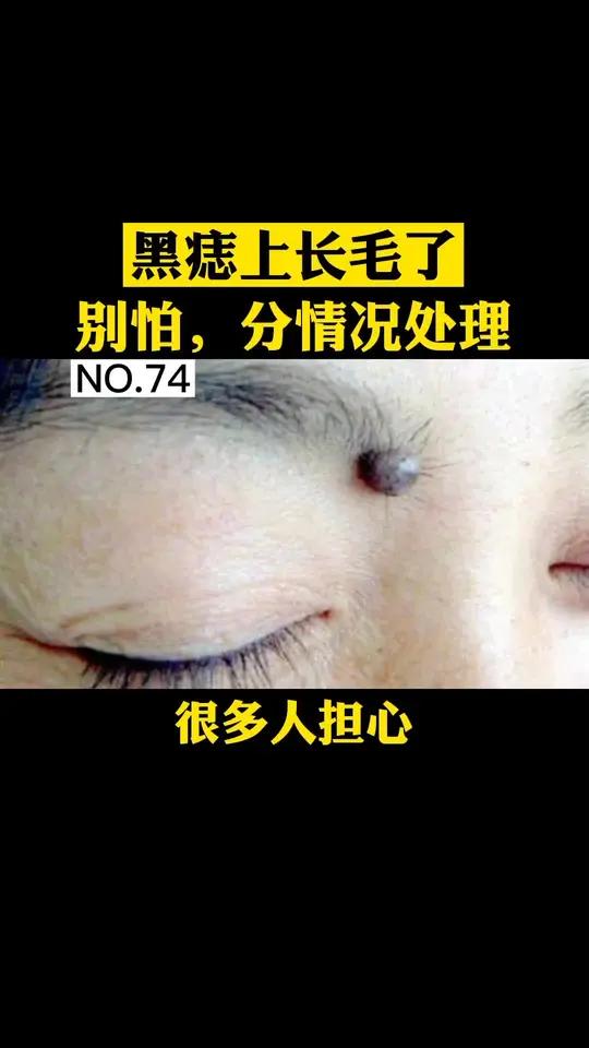 痣上面长了毛,会不会影响健康呢