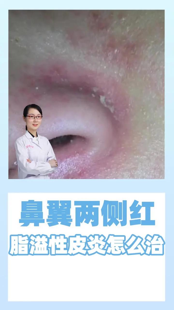 鼻翼两侧红 脂溢性皮炎怎么治