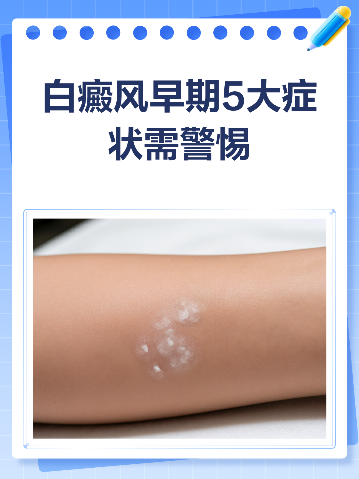 白癜风早期症状大揭秘,你中招了吗?