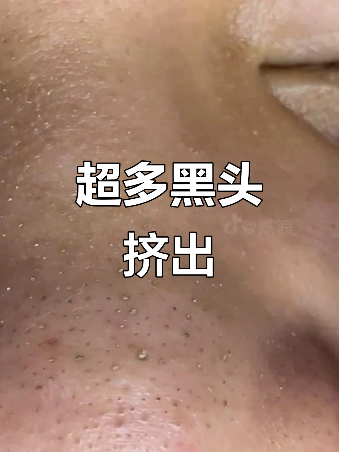 鼻子上的小黑头全挤出来,强迫症患者必看!