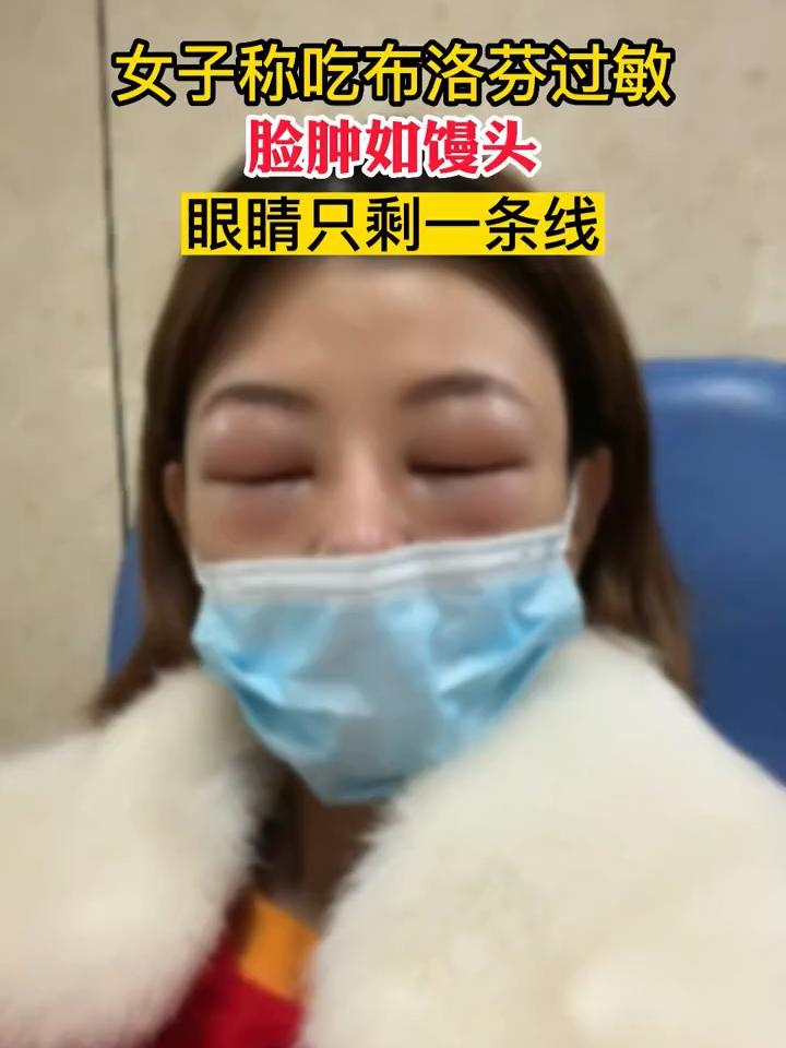海南海口,女子称吃布洛芬过敏脸肿如馒头:眼睛只剩一条线