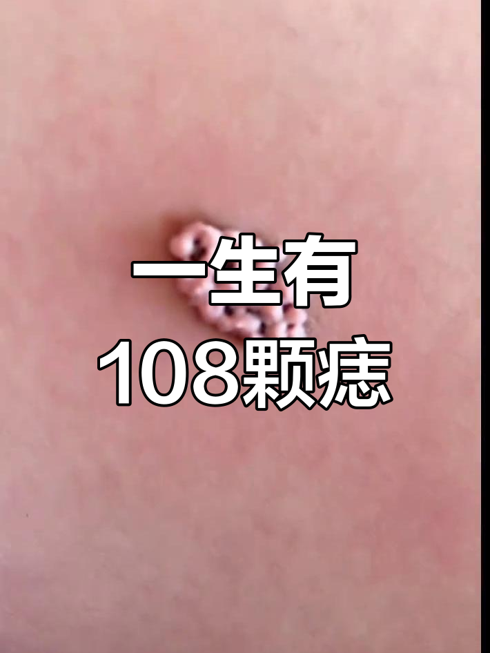 人为什么会长出痣为什么在线 人为什么会长出痣为什么在线