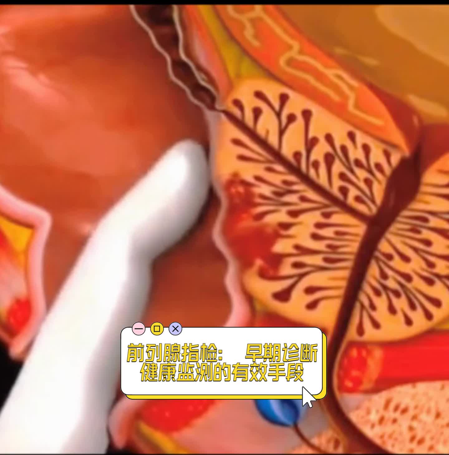 前列腺指检:早期诊断,健康监测的有效手段