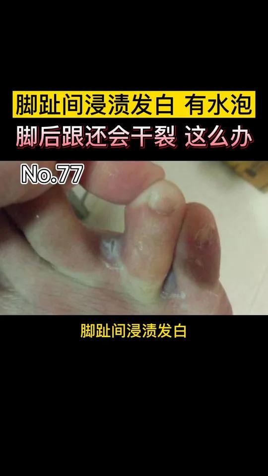 脚趾间发白,像被水泡过一样,还有小水泡,非常痒,可以这么办