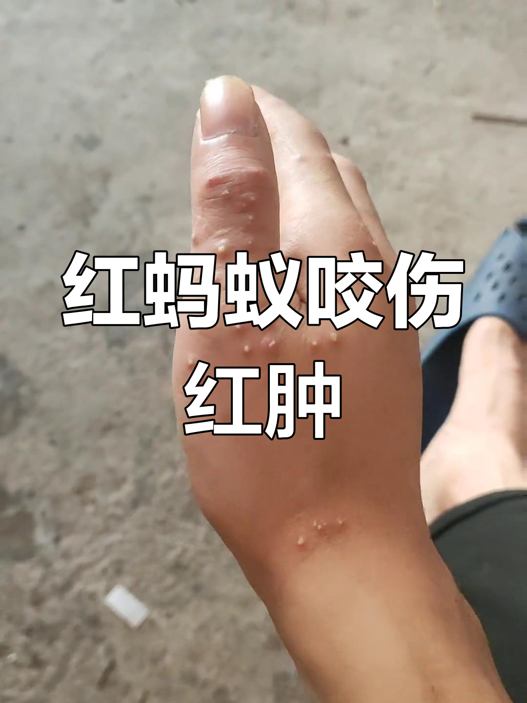 被红蚂蚁咬后,肿得厉害