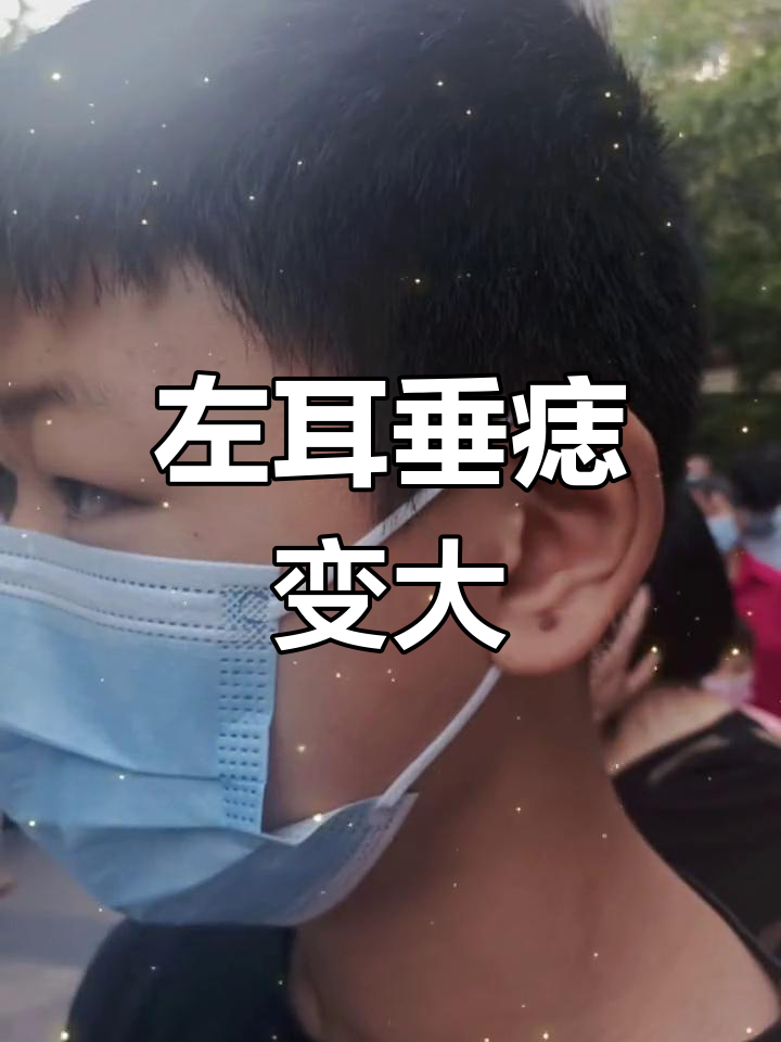 左耳垂痣越长越大,男孩的成长变化真有趣