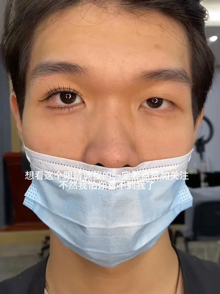 小眼睛三角眼单眼皮眼睛调整视频来了