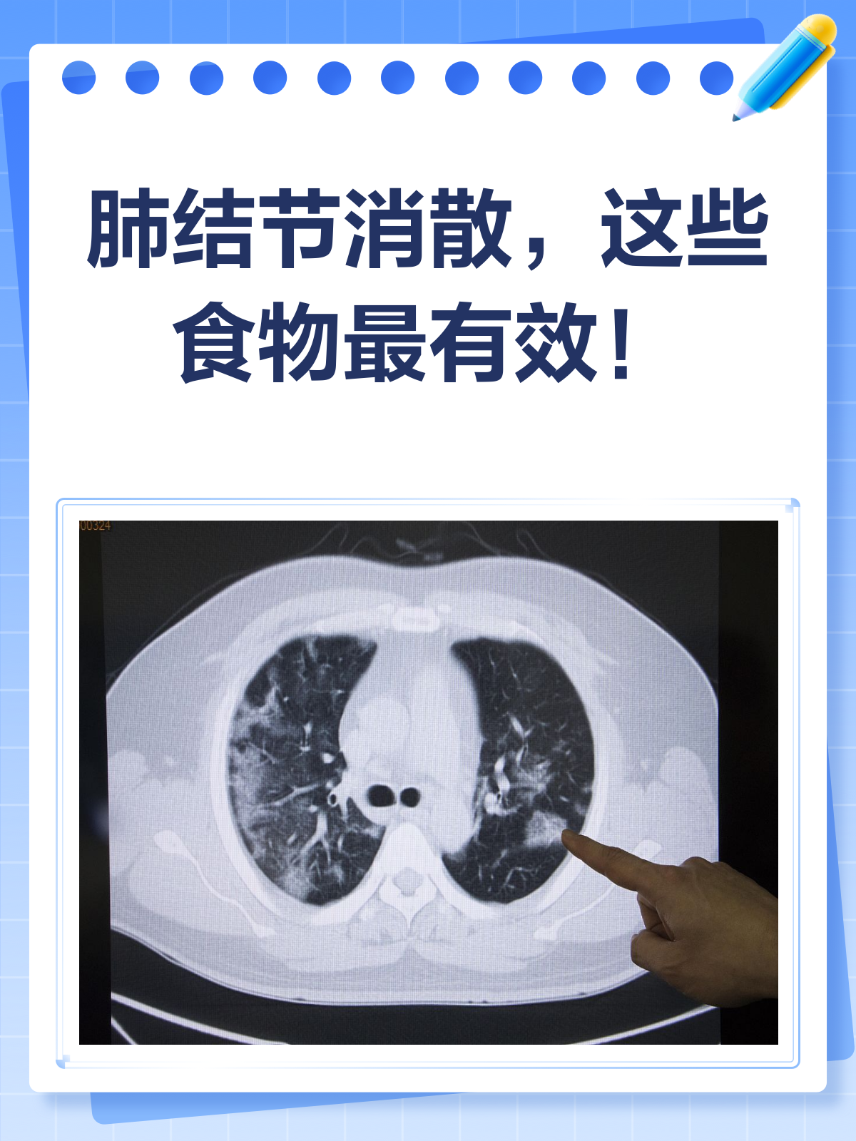 肺结节吃什么消结节最快最好(肺结节吃什么消结节最快最好中药)