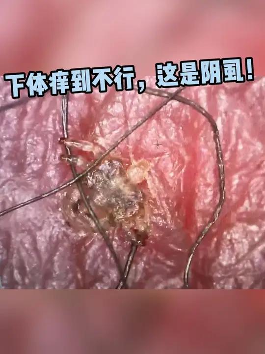 下体痒到不行,这是阴虱!阴虱