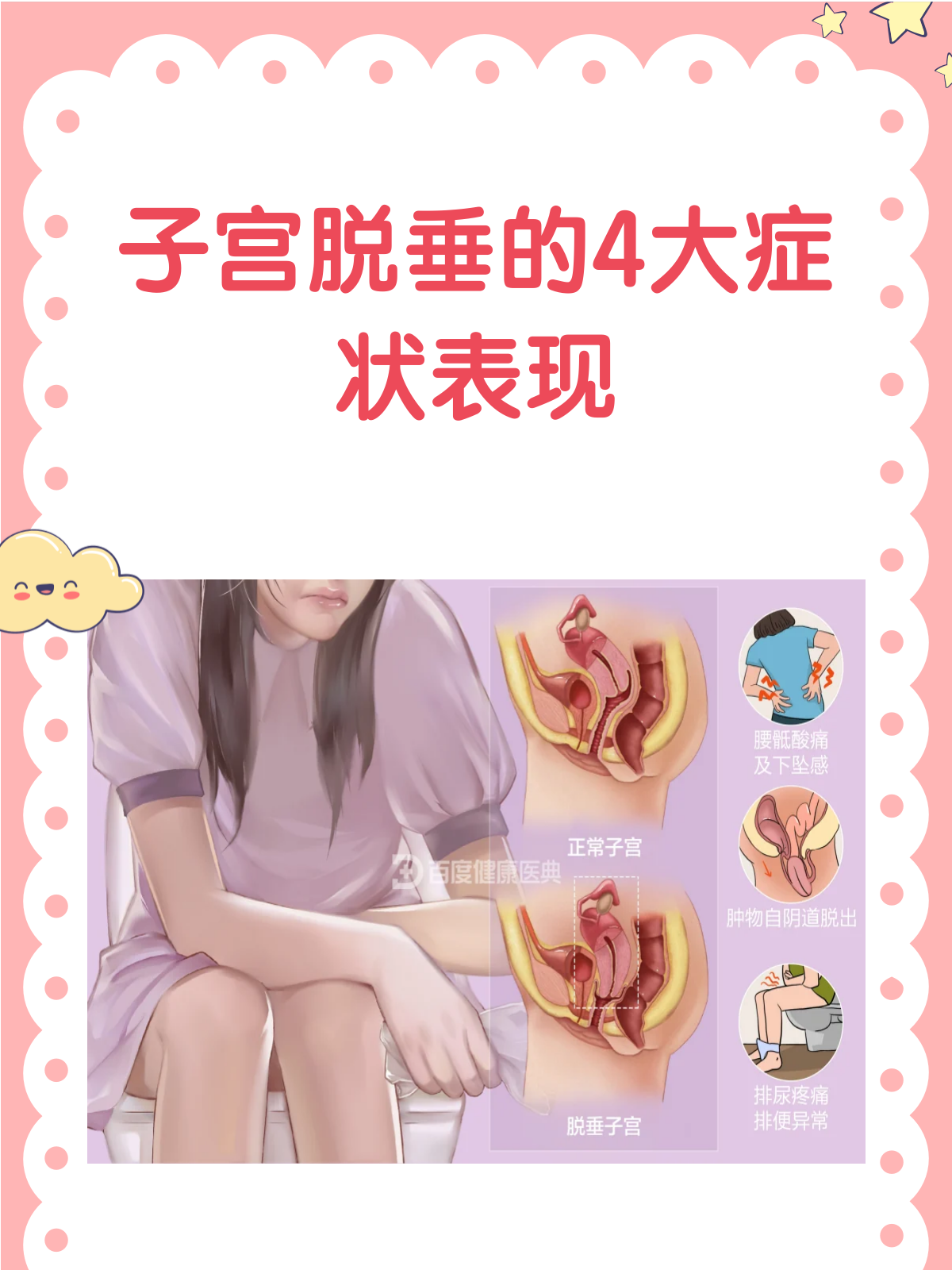 子宫脱垂来袭?这些症状需警惕!