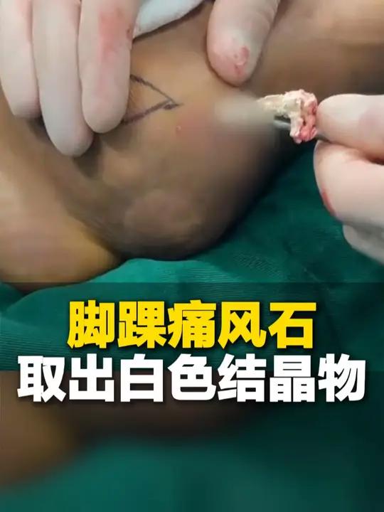 医生在男子痛风石中,取出大量白色结晶物!