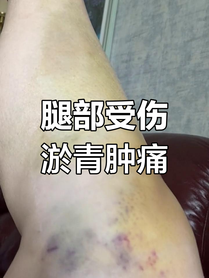 腿部撞伤一周后开始变紫,肿胀明显
