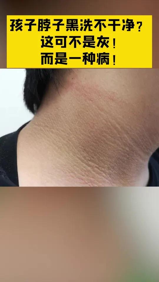 脖子上黑黑的,感觉像灰却去不掉,很有可能是这个原因,不要不当回事儿!