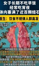 宁德女子长期不吃早饭，经常吃宵夜，体内塞满了近百颗结石！医生：饮食不规律人群高发！