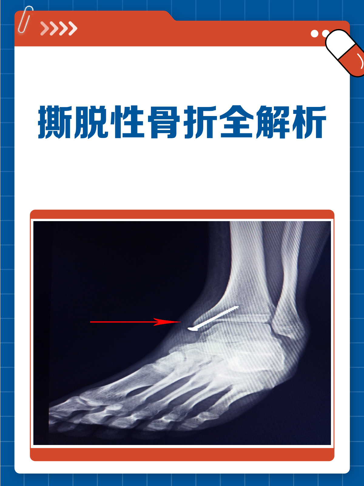 撕脱性骨折,你真的了解它吗?