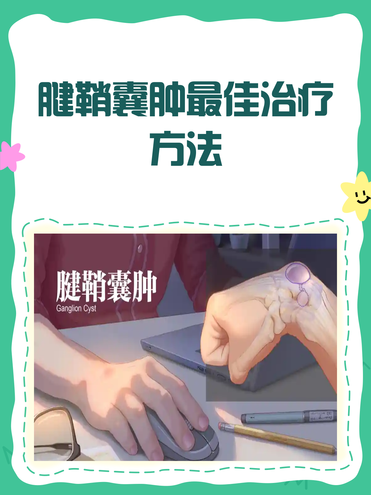 腱鞘囊肿治疗,哪种方法最适合你?