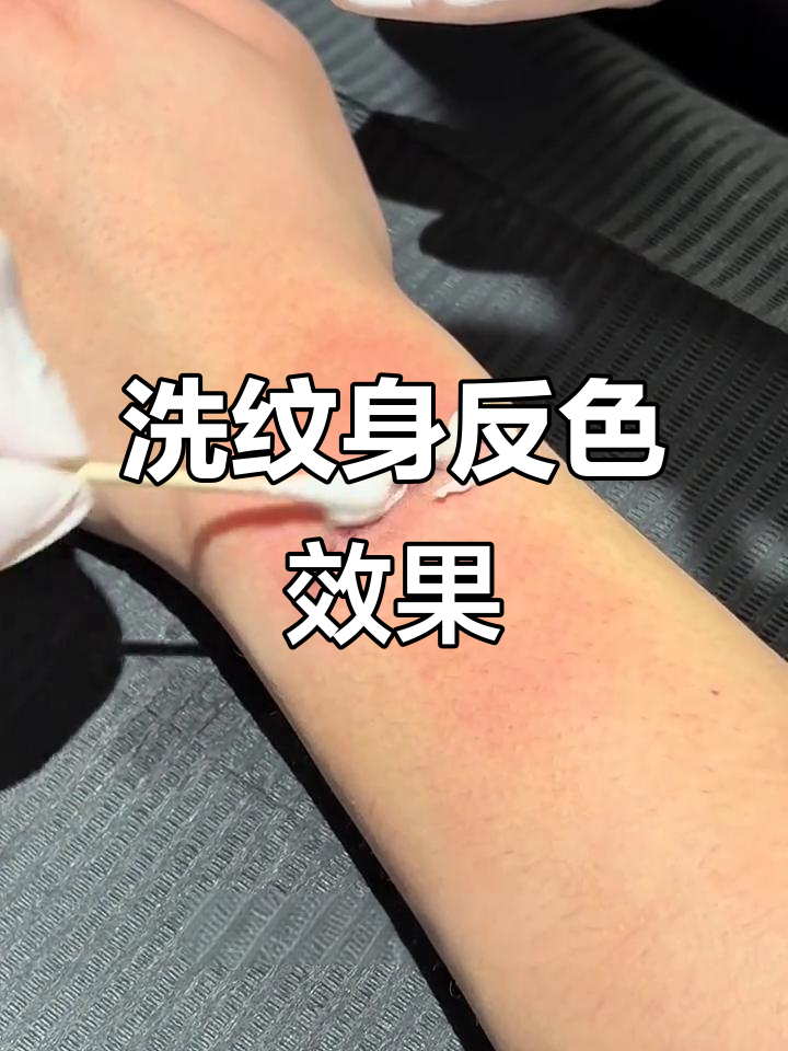 洗纹身不留疤,反色效果惊艳!第二次清洗过程全纪录