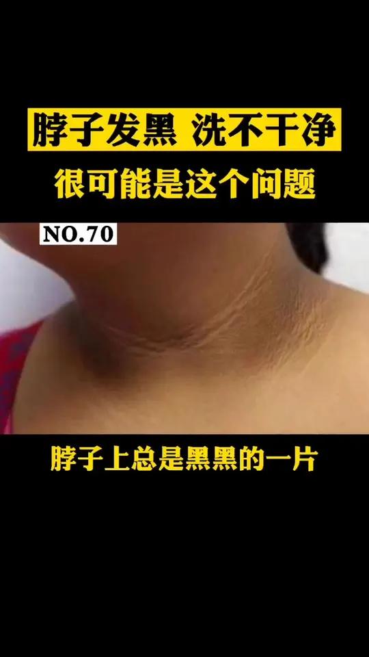 脖子上黑黑的一圈,总感觉没洗干净,看起来脏脏的,这可能是黑棘皮病