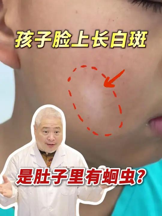 孩子脸上长这种白斑,是白色糠疹,别乱吃驱虫药了!