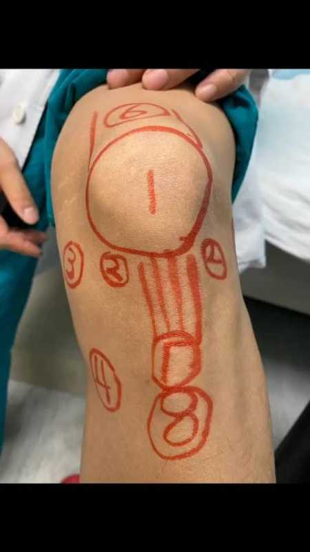 膝盖半月板半月板位置真人半月板损伤疼痛位置图膝关节疼痛位置图解