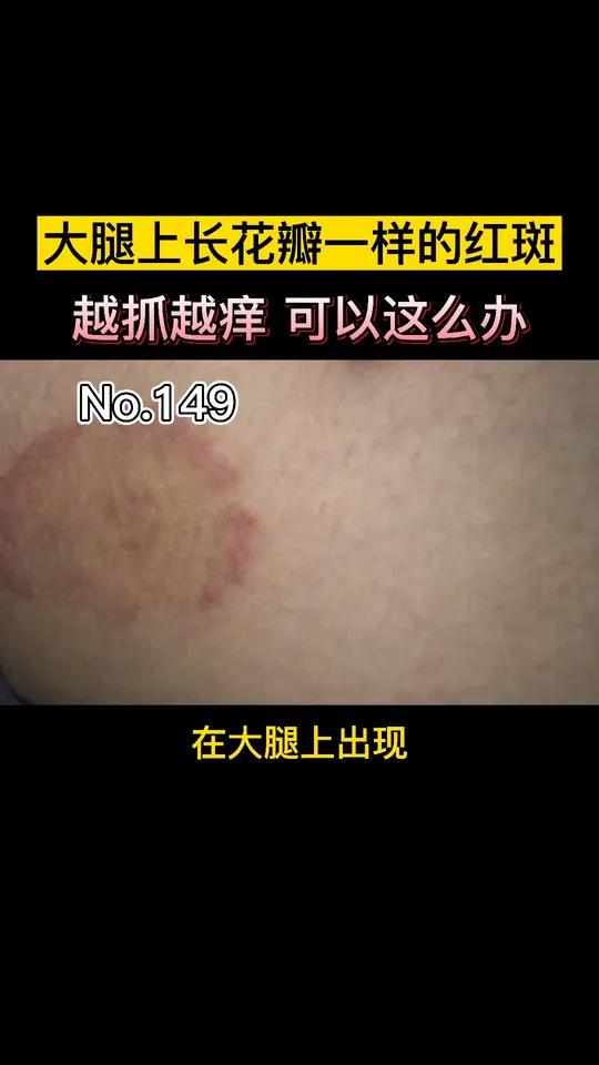 大腿上长环形的红斑,非常的痒,越抓会越痒,股癣我们可以这么办