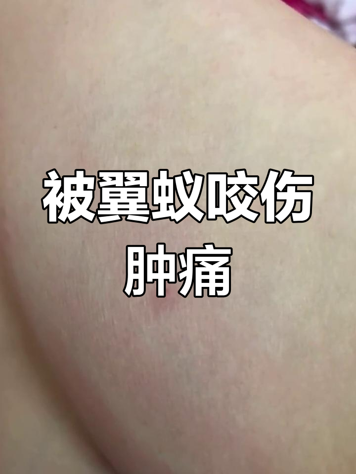 家里出现带翅膀蚂蚁,咬人后刺痛肿胀