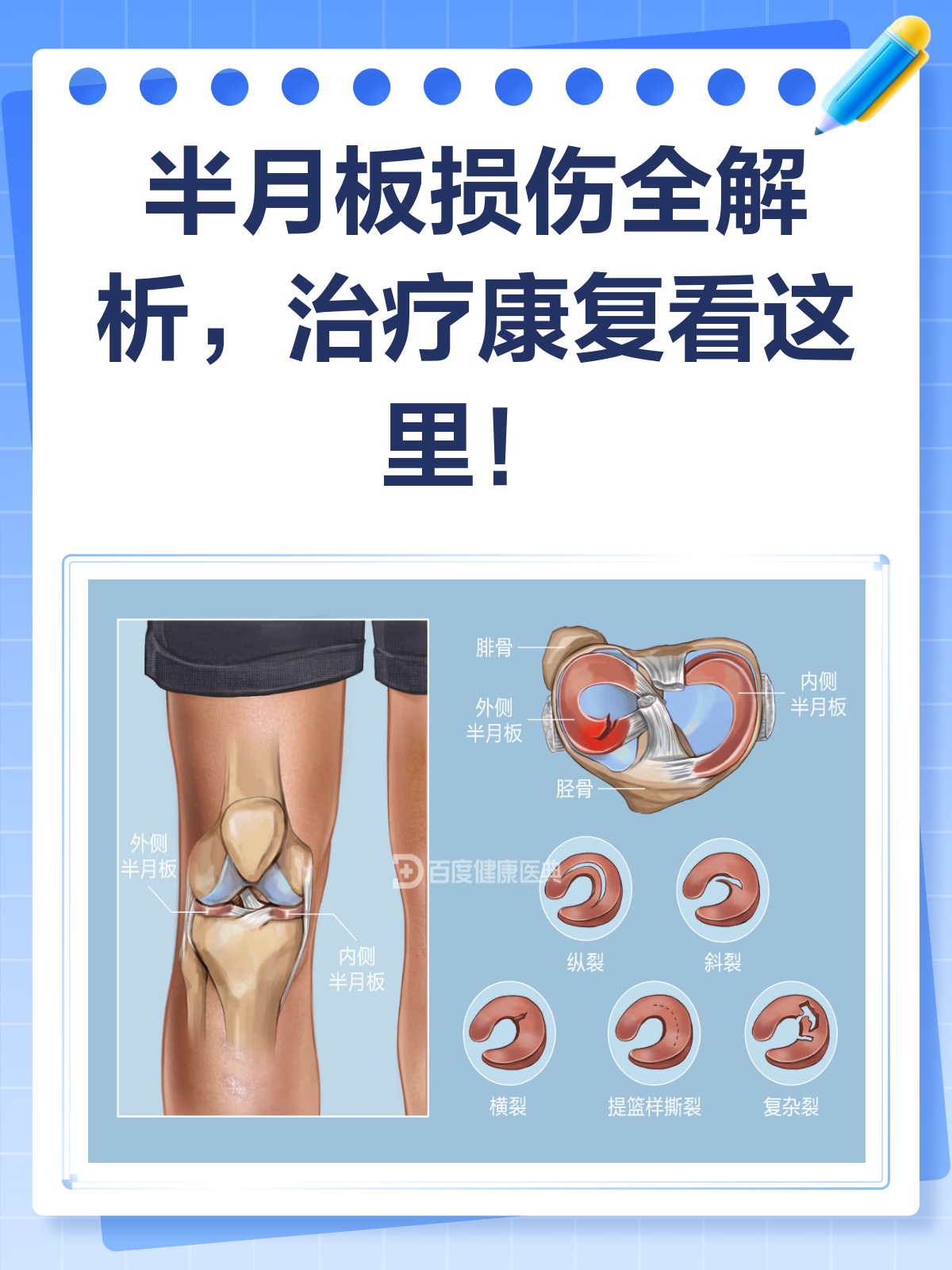 半月板损伤全解析!从原因到治疗一文读懂