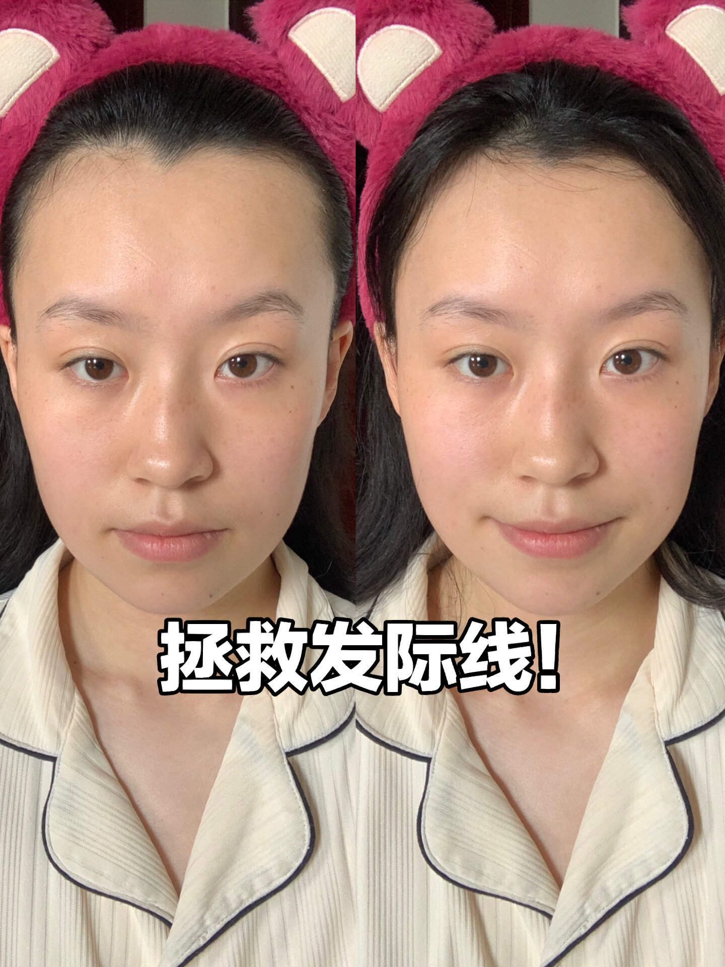 高发际线77美人尖77额头有旋 进来看!-度小视