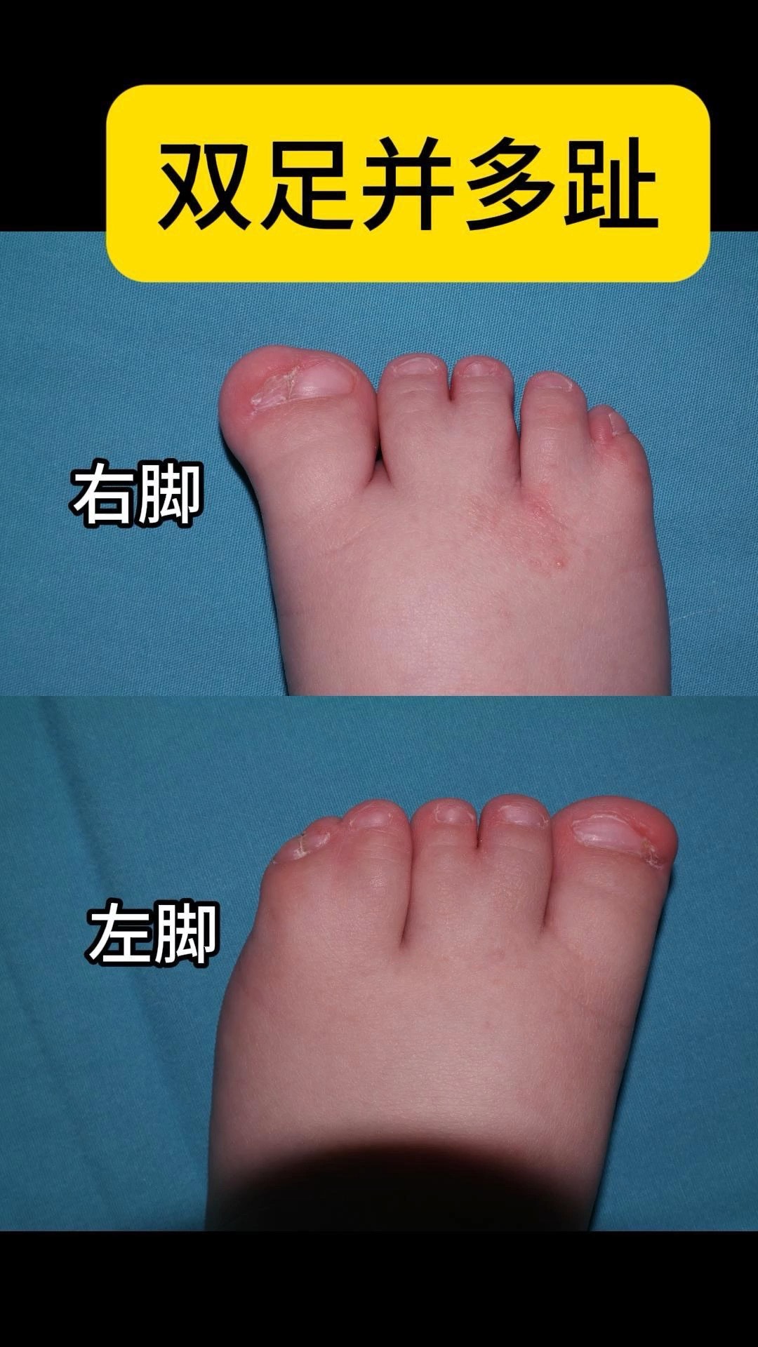 双足并多趾畸形,手术需要切除双足拇趾多趾;分离2