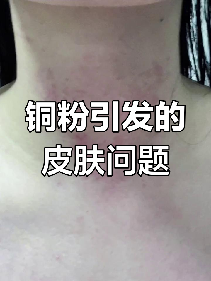 铜粉过敏引发脖子剧痒,洗澡后更严重