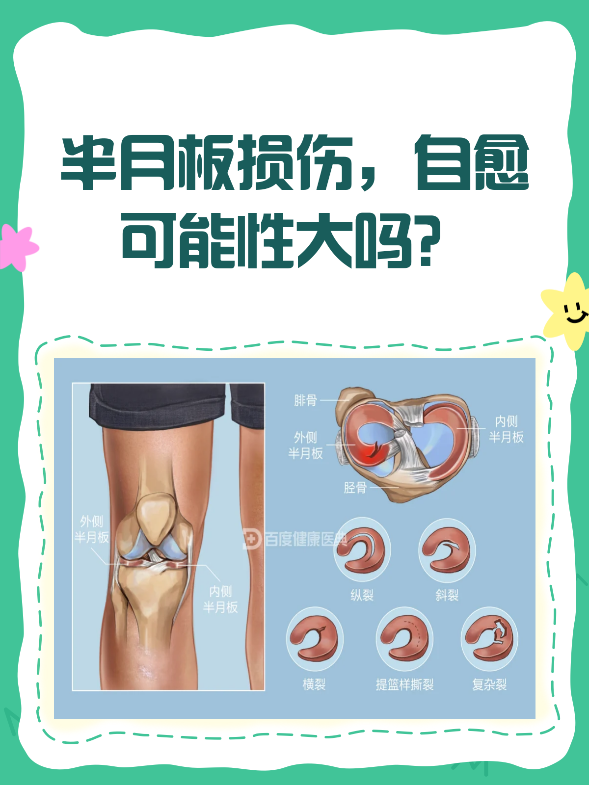半月板损伤,真的能自愈吗?